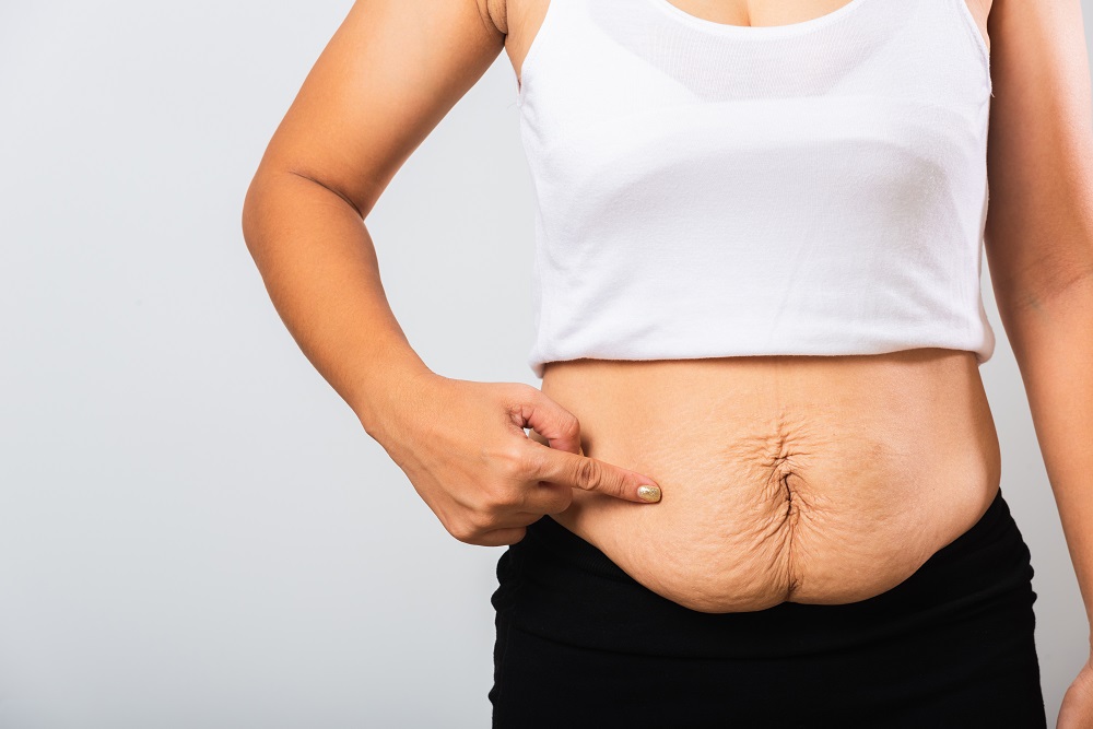 Saggy Belly Skin After Pregnancy: What To Do And What To Avoid