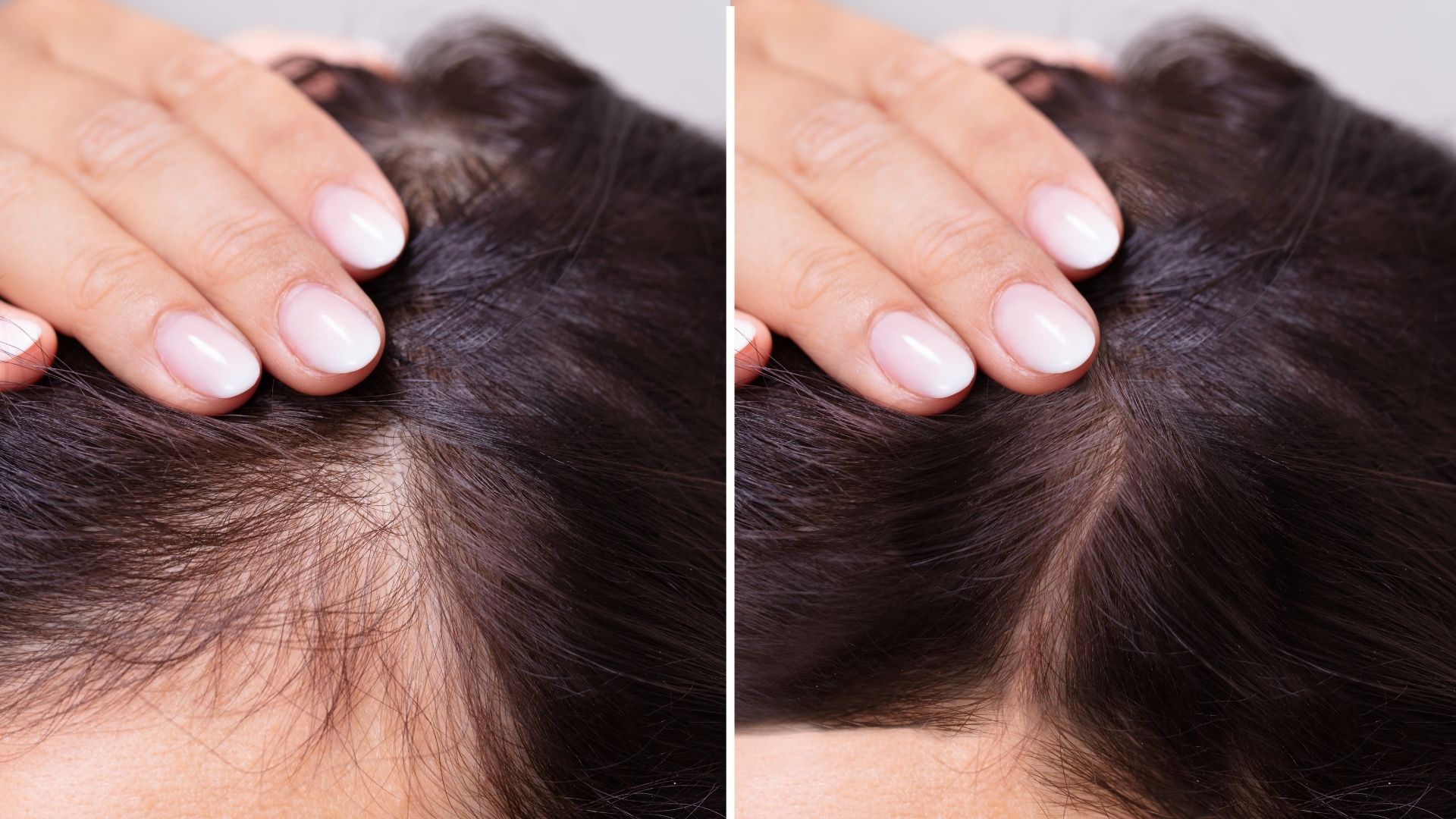 Hair Loss After Bariatric Surgery: Causes & Treatment