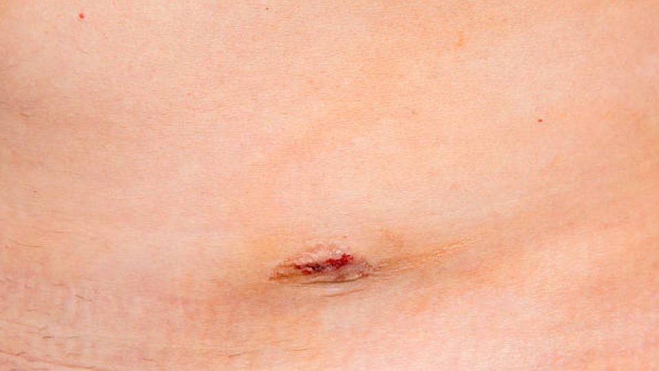 gastric sleeve incisions