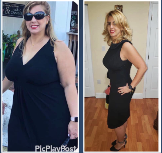 Before And After Bariatric Surgery - 4