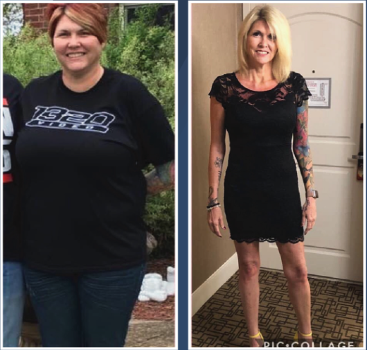 Before And After Bariatric Surgery - 6